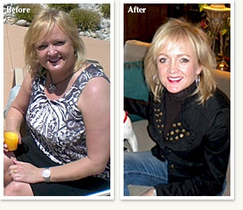 Pam before and after losing 53 pounds with weight loss Doctor Ethan Lazarus