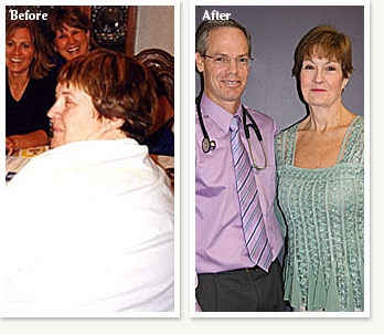 Peggy before and after losing 221 pounds posing with her obesity medicine weight loss doctor Ethan Lazarus