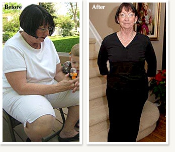 Nancy before and after losing 39 pounds with Dr Ethan Lazarus in Denver Colorado