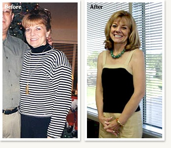 Sally before and after losing 23 pounds with Dr Ethan Lazarus in Greenwood Village Colorado