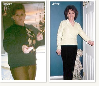 Bonnie before and after 32 pound medical weight loss with Dr Ethan Lazarus in Denver Colorado
