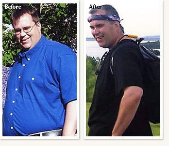 Ed before and after losing 108 pounds with Dr Ethan Lazarus in Greenwood Village Colorado
