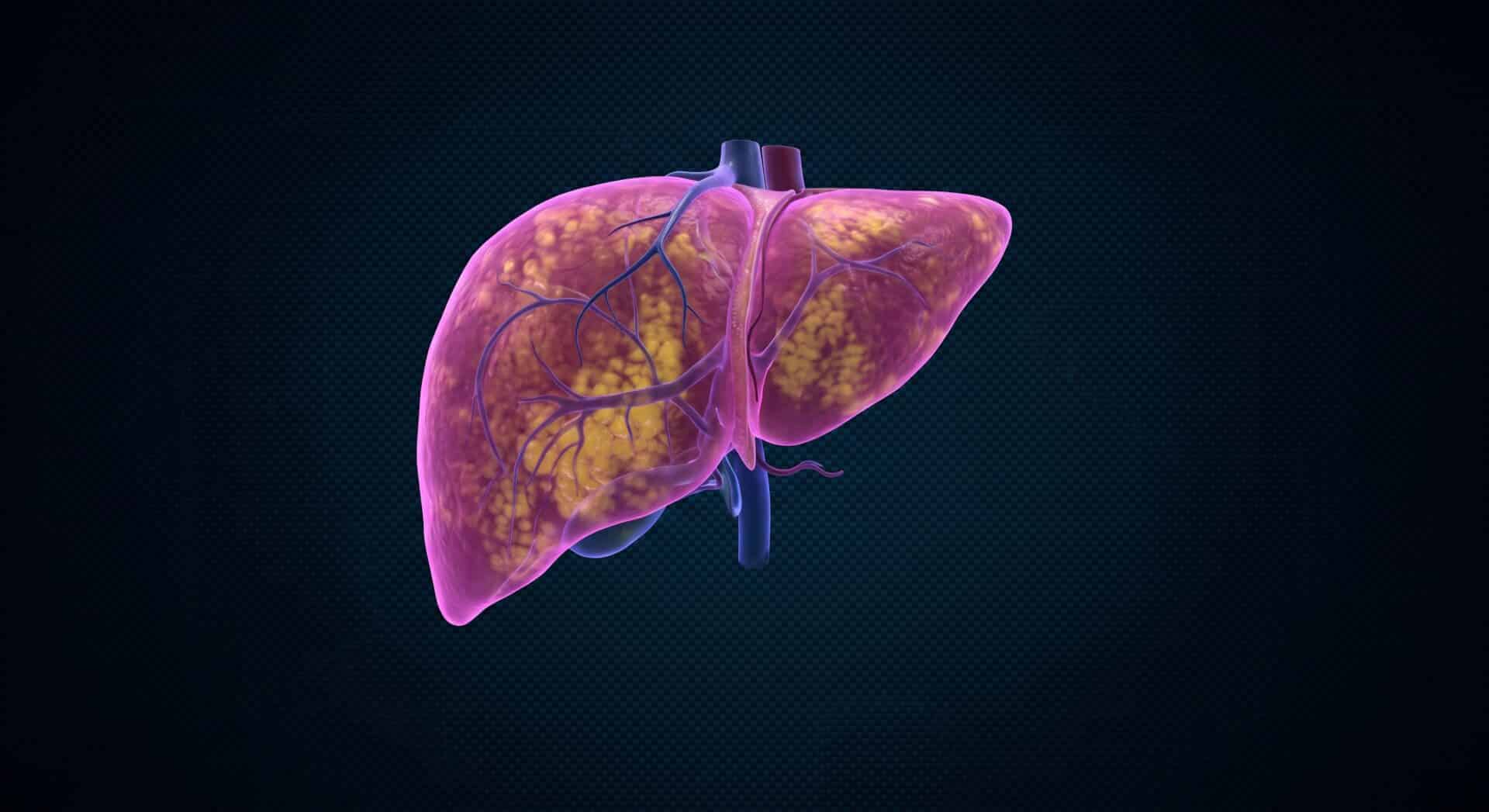 | Clinical Nutrition Center Fatty Liver Disease (MASH)